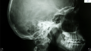 Dental X-Rays Linked to the Most Common Brain Tumors